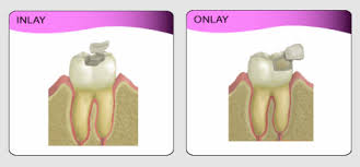 Inlay/Onlay (CAD)